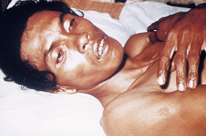 cholera victim